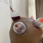 Diploma in Cupping Therapy | Dr. Hitesh Kamble