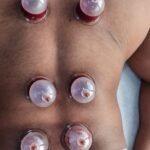 Diploma in Cupping Therapy | Dr. Hitesh Kamble