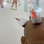 Diploma in Cupping Therapy | Dr. Hitesh Kamble