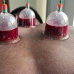 Cupping Therapy | Adiyogi Cupclinic